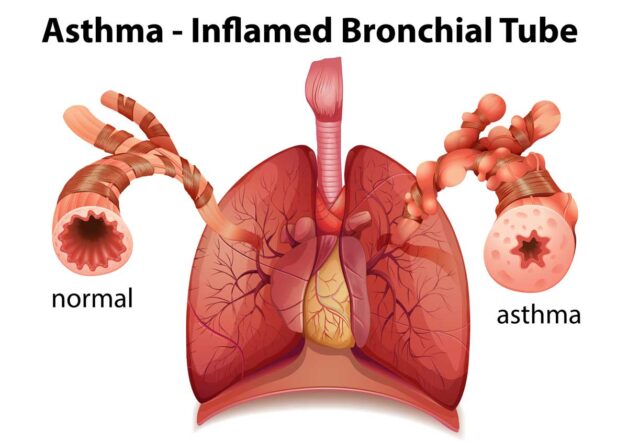 Cách chăm sóc trẻ bị hen suyễn bố mẹ phải biết