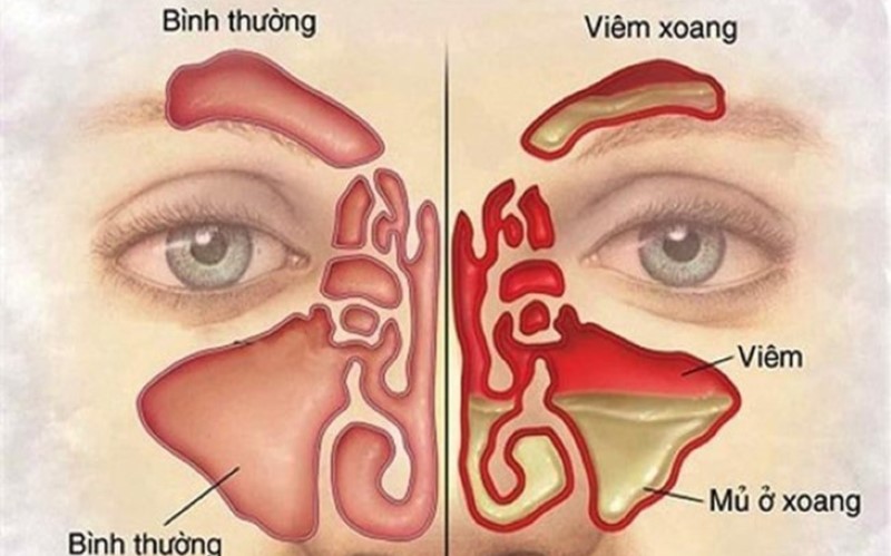 Cách chăm sóc và điều trị bệnh viêm xoang mũi