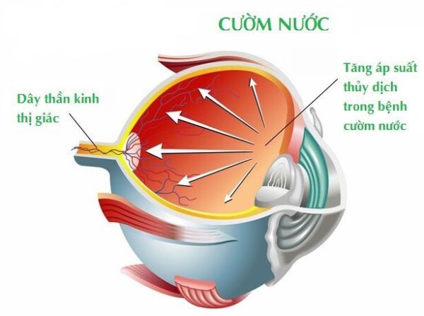 Cách chẩn đoán và nguyên nhân bệnh glocom cườm nước