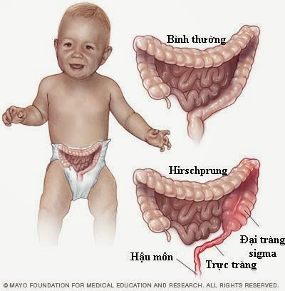 Cách chữa bệnh phình đại tràng bẩm sinh