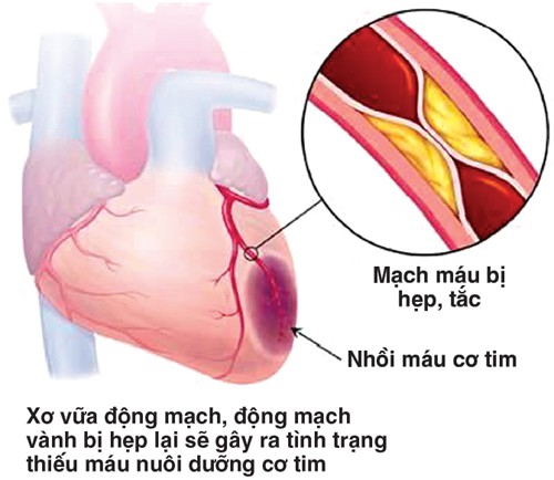 Cách chữa bệnh tim lớn cần tim hiểu đúng nguyên nhân