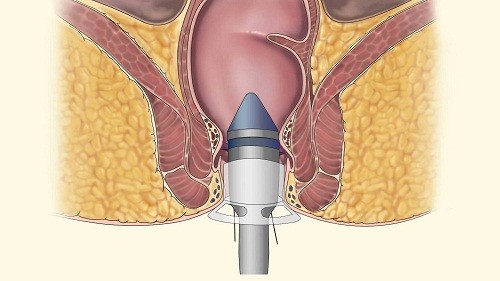 Cách chữa bệnh trĩ điều chỉnh lại lối sống