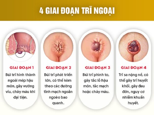 Cách chữa bệnh trĩ ngoại hiệu quả