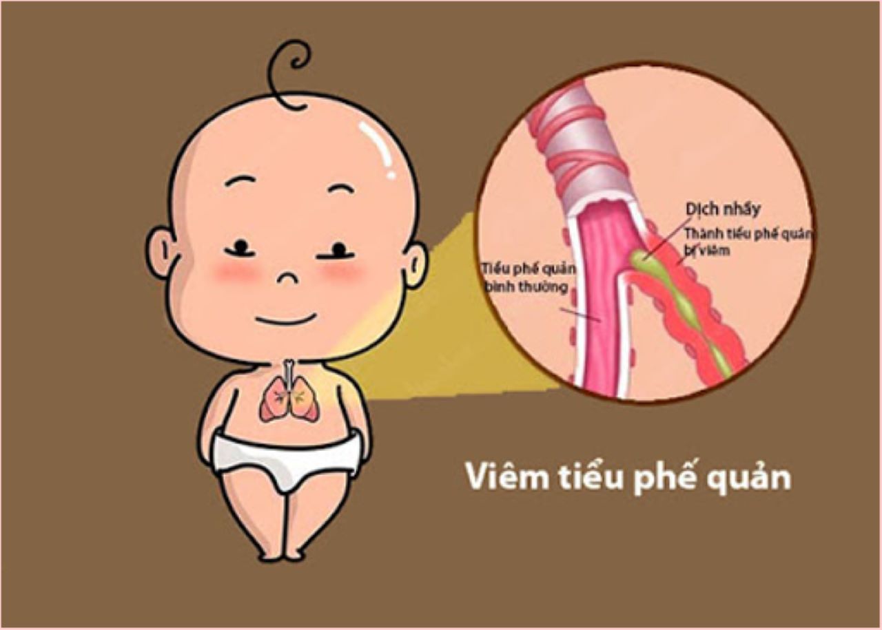 Cách chữa bệnh viêm tiểu phế quản ở trẻ em phụ huynh nên biết