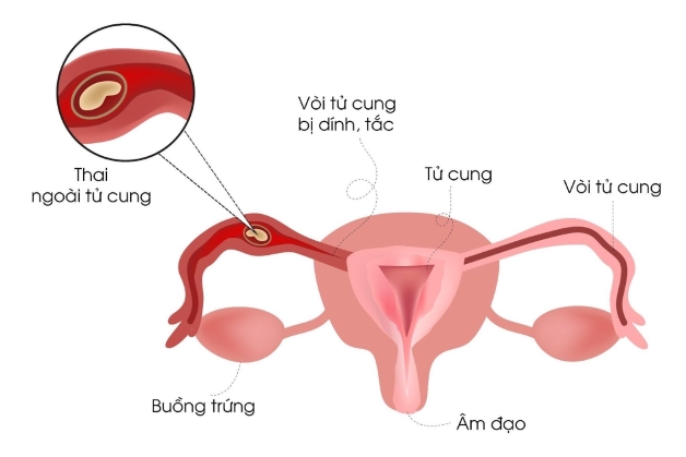 Cách chữa chửa ngoài dạ con ra sao?