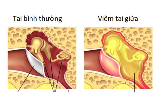 Cách chữa đau tai hiệu quả và dễ áp dụng tại nhà