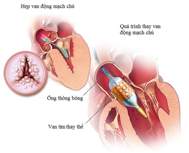 Cách chữa đột quỵ hiệu quả hiện nay