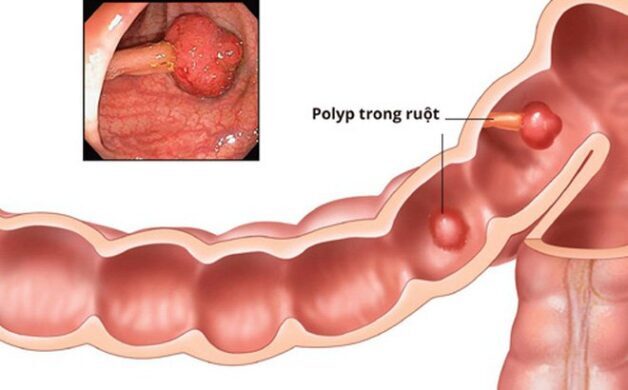 Cách chữa polyp đại tràng cần biết