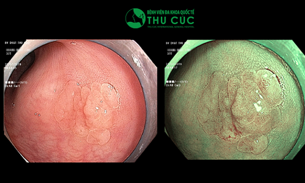 Cách chữa polyp đại tràng cần biết