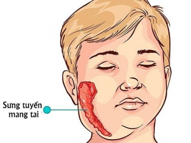 Cách chữa quai bị bằng mật ong có hiệu quả không?