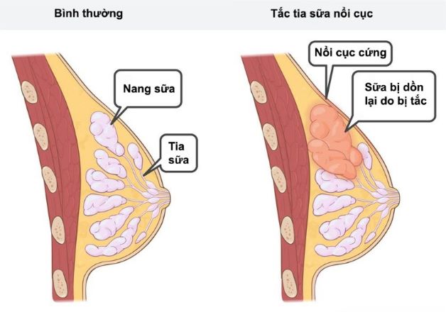 Cách chữa tắc tia sữa vón cục hiệu quả cho mẹ tại nhà