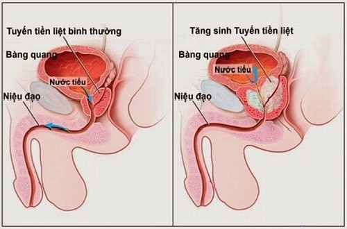 Cách chữa tiểu nhiều lần đúng cách, phù hợp