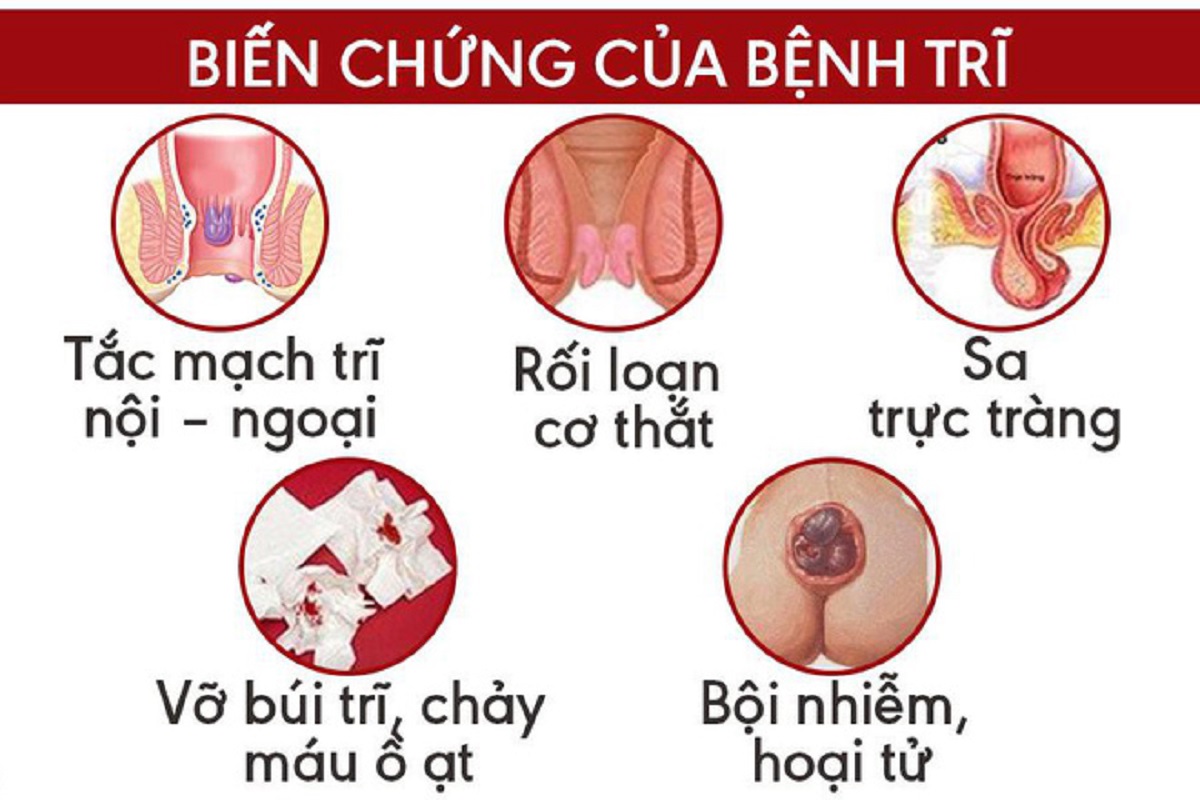 Cách chữa trị bệnh trĩ hiệu quả