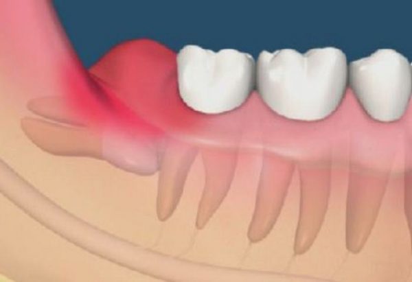 Cách chữa trị chứng đau răng khi nhai