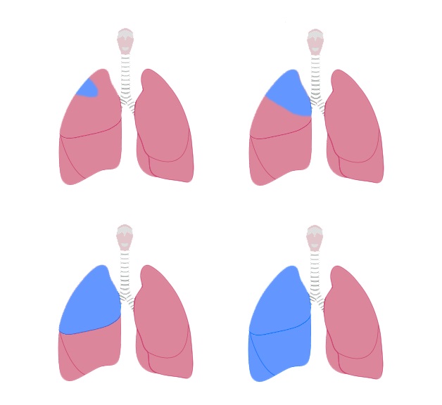 Cách chữa trị ung thư phổi bằng phẫu thuật