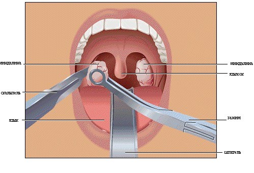 Cách chữa viêm amidan hốc mủ dễ xâm nhập gây viêm