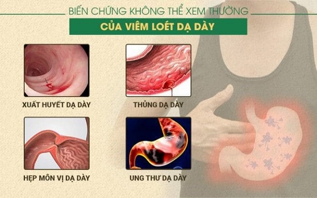 Cách chữa viêm dạ dày tá tràng hiệu quả nhanh