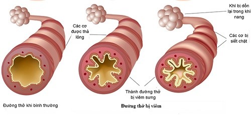 Cách chữa viêm phế quản mạn tính ảnh hưởng xấu tới sức khỏe