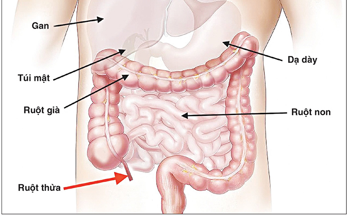 Cách chữa viêm ruột hiệu quả không phải ai cũng biết 