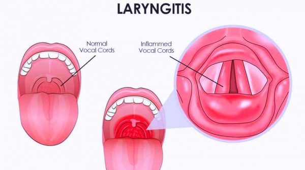 Cách chữa viêm thanh quản tại nhà, bạn đã biết?