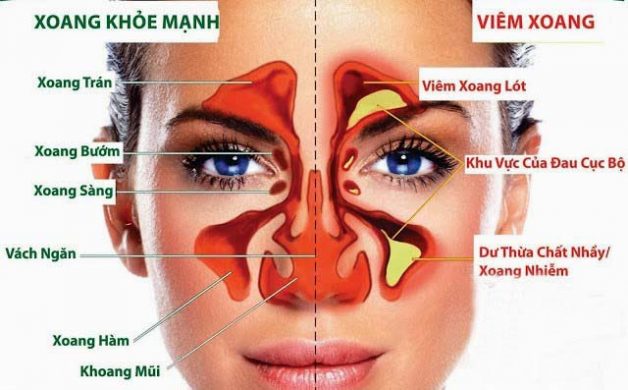 Cách chữa viêm xoang mũi được các cơ sở y tế uy tín áp dụng