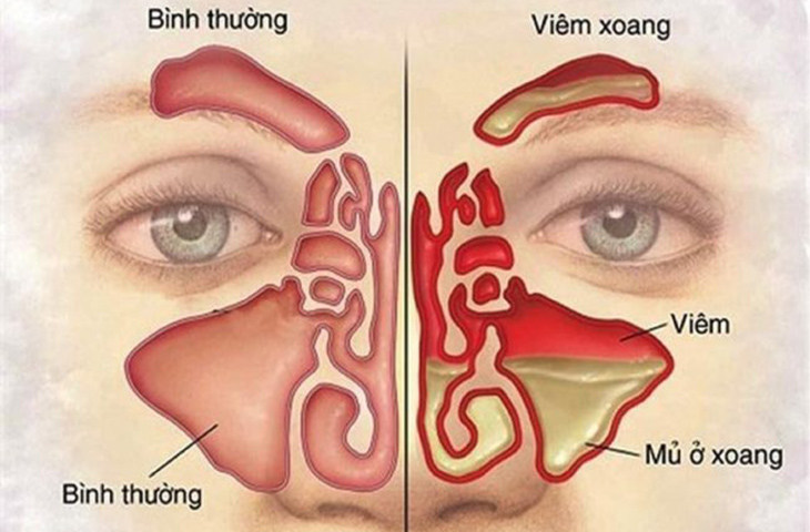 Cách chữa viêm xoang mũi hiệu quả, miễn phí