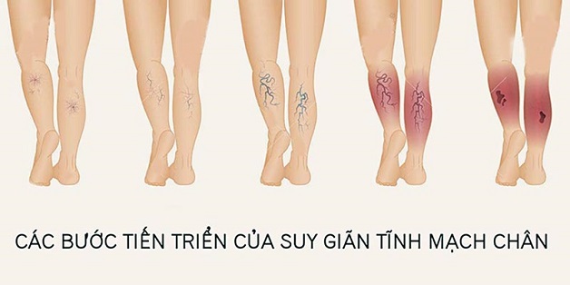 Cách dễ ngủ cho người mất ngủ vì suy giãn tĩnh mạch