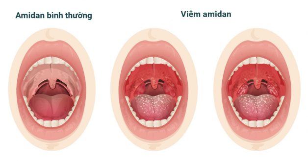 Cách điều trị Amidan hiệu quả nhất hiện nay