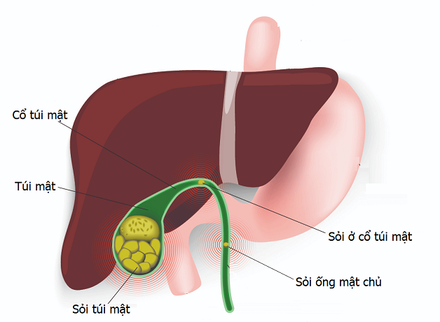 Cách điều trị bệnh sỏi mật – những phương pháp phổ biến