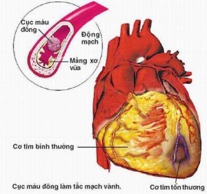 Cách điều trị bệnh tim thiếu máu