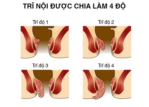 Cách điều trị bệnh trĩ độ 3 chữa trị như thế nào để đạt hiệu quả