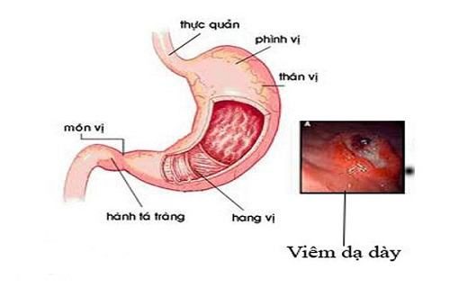 Cách điều trị bệnh viêm dạ dày mạn tính