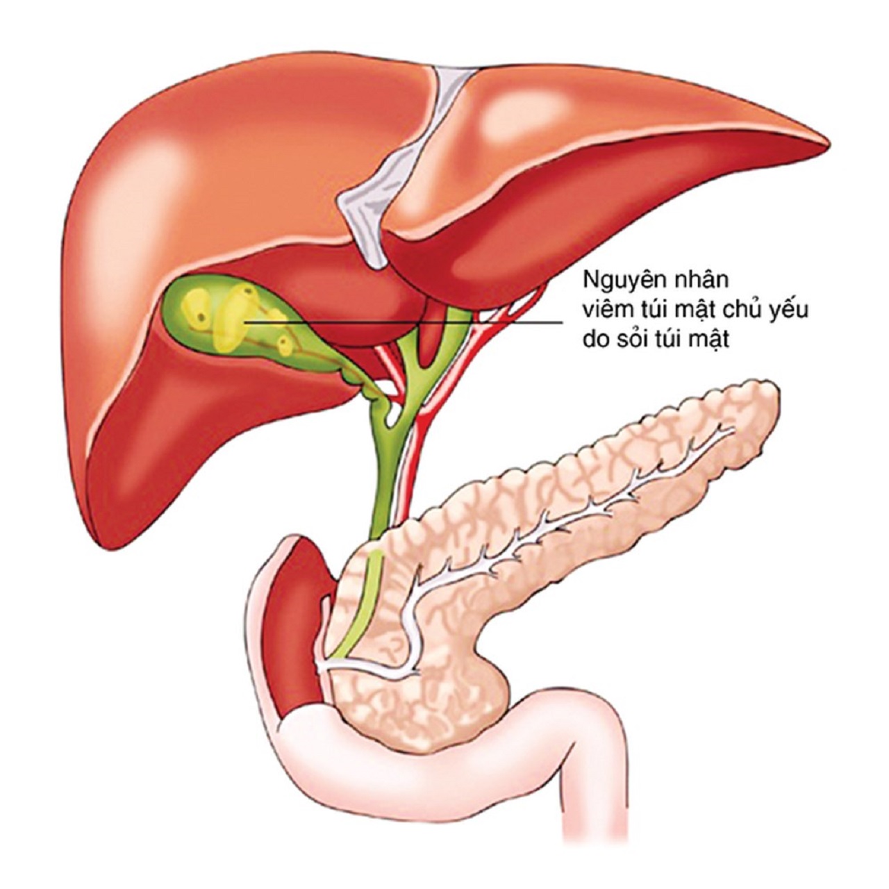 Cách điều trị bệnh viêm túi mật hiệu quả