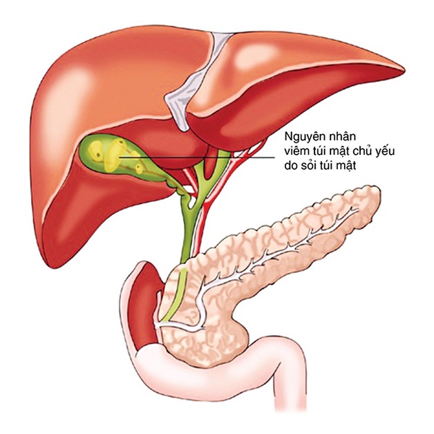 Cách điều trị bệnh viêm túi mật hiệu quả