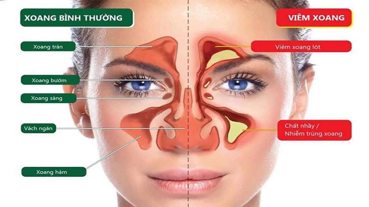 Cách điều trị bệnh viêm xoang mũi hiệu quả