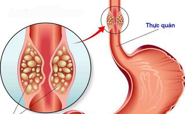 Cách điều trị đau dạ dày bị nấc hiệu quả nhất