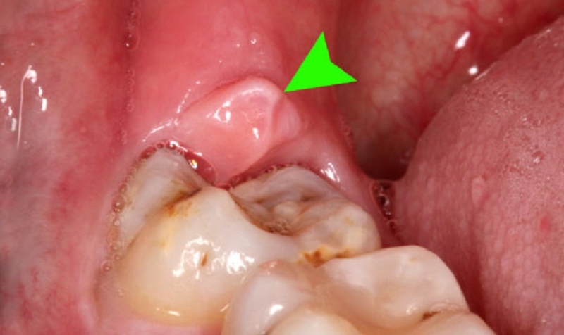 Cách điều trị khi bị viêm nướu răng trong cùng