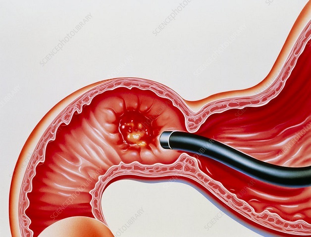 Cách điều trị loét tá tràng, nguyên nhân và triệu chứng