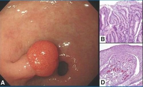 Cách điều trị polyp dạ dày