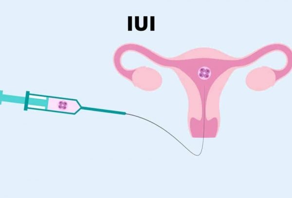 Cách điều trị rối loạn phóng noãn như thế nào?