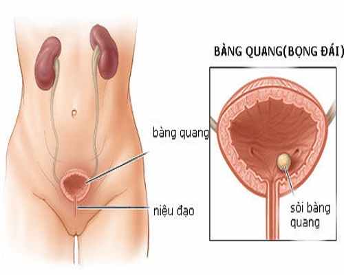 Cách điều trị sỏi bàng quang – nhận biết những triệu chứng thường gặp