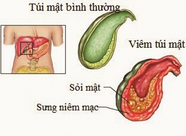 Cách điều trị sỏi mật bạn cần biết