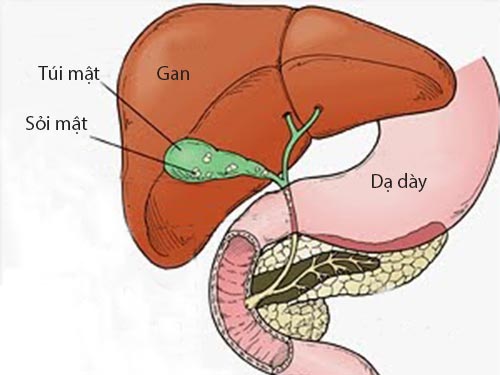 Cách điều trị sỏi mật hiệu quả ngay tại Thu Cúc