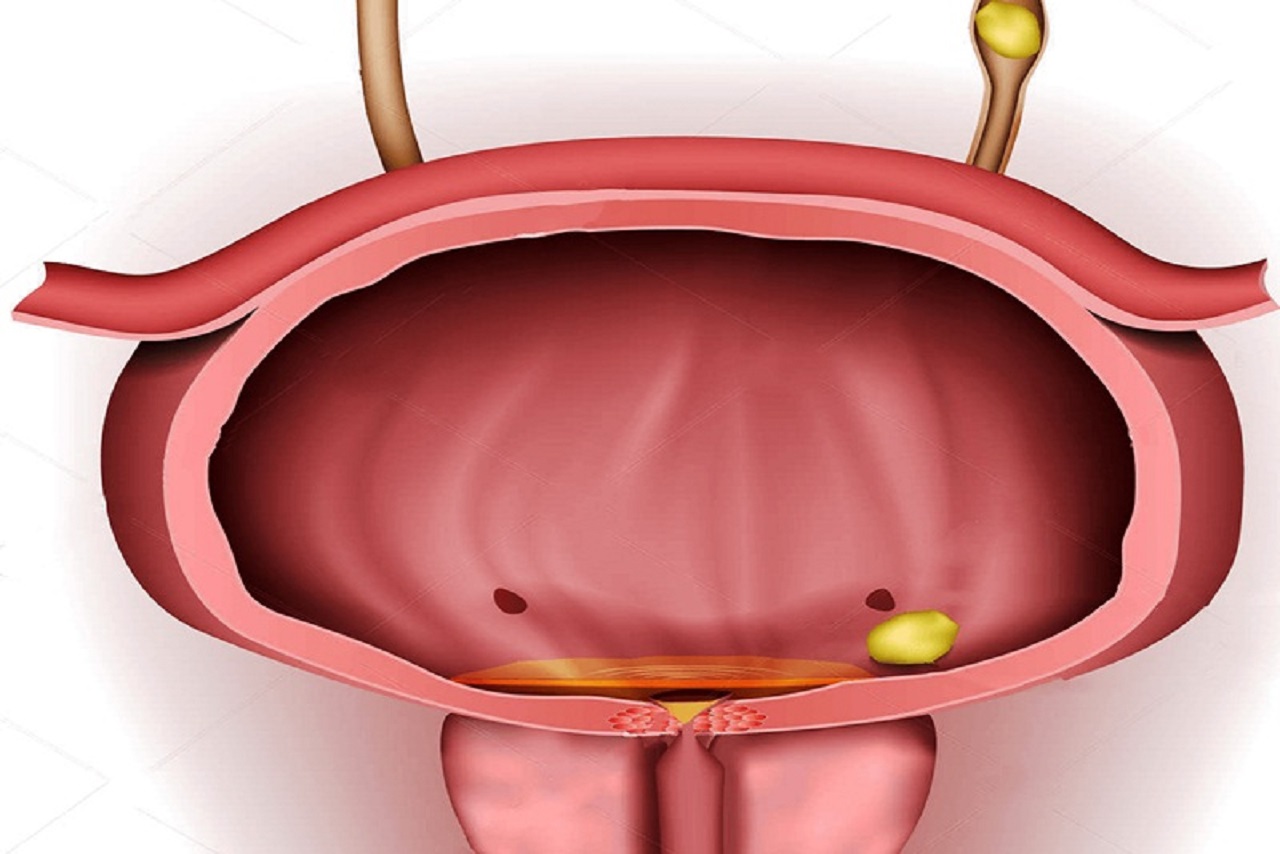 Cách điều trị sỏi tiết niệu – sỏi thận rơi xuống bàng quang