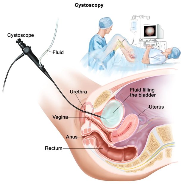 Cách điều trị sỏi tiết niệu – sỏi thận rơi xuống bàng quang