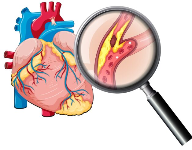 Cách điều trị thiếu máu cơ tim giúp đạt hiệu quả cao