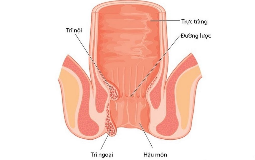 Cách điều trị trĩ ngoại hiệu quả – Góc giải đáp