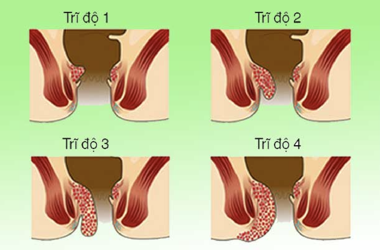 Cách điều trị trĩ nội hiệu quả – Góc giải đáp