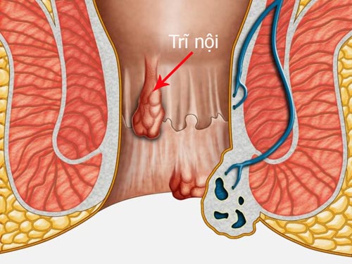 Cách điều trị trĩ nội hiệu quả – Góc giải đáp