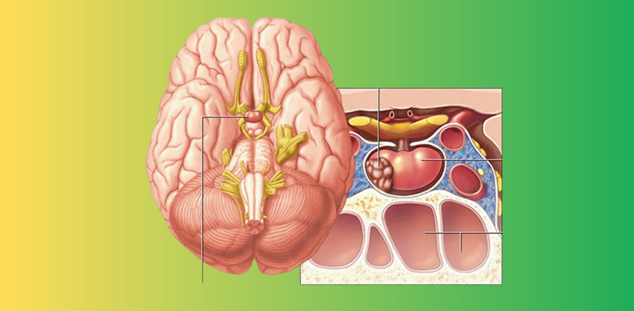 Cách điều trị u tuyến yên phổ biến hiện nay